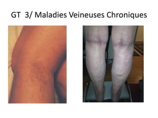 GT 3/ Maladies Veineuses Chroniques
 
