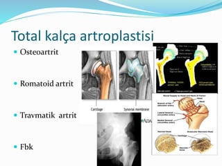 Total kalça artroplastisi
 Osteoartrit
 Romatoid artrit
 Travmatik artrit
 Fbk
 