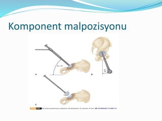Komponent malpozisyonu
 