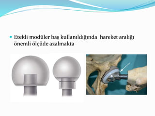  Etekli modüler baş kullanıldığında hareket aralığı
önemli ölçüde azalmakta
 