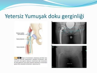 Yetersiz Yumuşak doku gerginliği
 