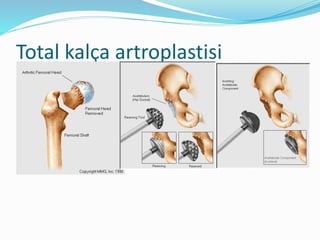 Total kalça artroplastisi
 