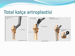 Total kalça artroplastisi
 