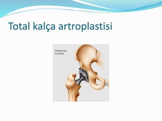 Total kalça artroplastisi
 