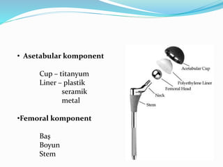 • Asetabular komponent
Cup – titanyum
Liner – plastik
seramik
metal
•Femoral komponent
Baş
Boyun
Stem
 