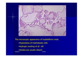 The microscopic appearance of hydatidiform mole:
•Hyperplasia of trophobasitc cells
•Hydropic swelling of all villi
•Vessles are usually absent
1919--SepSep--1212 o wardao warda
 