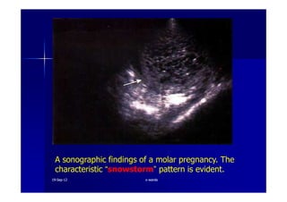 A sonographic findings of a molar pregnancy. The
characteristic “snowstorm” pattern is evident.
1919--SepSep--1212 o wardao warda
 