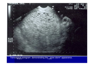 Transvaginal sonogram demonstrating the “ snow storm” appearance.1919--SepSep--1212 o wardao warda
 