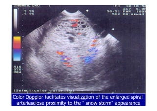 Color Dopplor facilitates visualization of the enlarged spiral
arteriesclose proximity to the “ snow storm” appearance
1919--SepSep--1212 o wardao warda
 