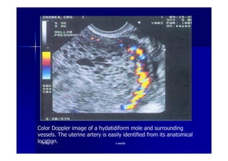 Color Doppler image of a hydatidiform mole and surrounding
vessels. The uterine artery is easily identified from its anatomical
location.1919--SepSep--1212 o wardao warda
 