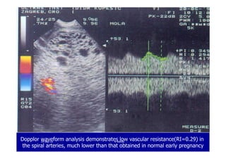 Dopplor waveform analysis demonstrates low vascular resistance(RI=0.29) in
the spiral arteries, much lower than that obtained in normal early pregnancy
1919--SepSep--1212 o wardao warda
 
