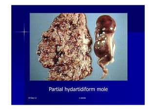 Partial hydartidiform mole
1919--SepSep--1212 o wardao warda
 