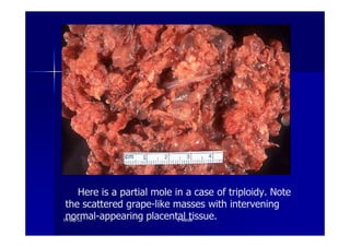 Here is a partial mole in a case of triploidy. Note
the scattered grape-like masses with intervening
normal-appearing placental tissue.1919--SepSep--1212 o wardao warda
 