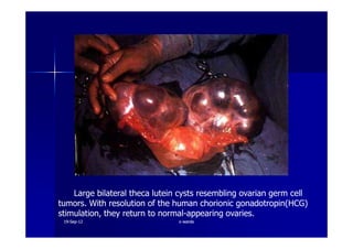 Large bilateral theca lutein cysts resembling ovarian germ cell
tumors. With resolution of the human chorionic gonadotropin(HCG)
stimulation, they return to normal-appearing ovaries.
1919--SepSep--1212 o wardao warda
 