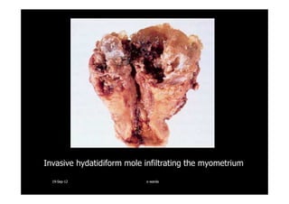 Invasive hydatidiform mole infiltrating the myometrium
1919--SepSep--1212 o wardao warda
 