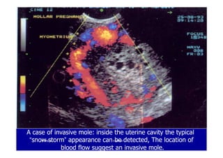 A case of invasive mole: inside the uterine cavity the typicalA case of invasive mole: inside the uterine cavity the typical
““snow stormsnow storm”” appearance can be detected, The location ofappearance can be detected, The location of
blood flow suggest an invasive mole.blood flow suggest an invasive mole.
1919--SepSep--1212 o wardao warda
 
