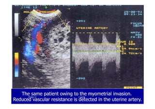 The same patient owing to the myometrial invasion.The same patient owing to the myometrial invasion.
Reduced vascular resistance is detected in the uterine artery.Reduced vascular resistance is detected in the uterine artery.
1919--SepSep--1212 o wardao warda
 
