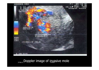 Doppler image of invasive mole1919--SepSep--1212 o wardao warda
 