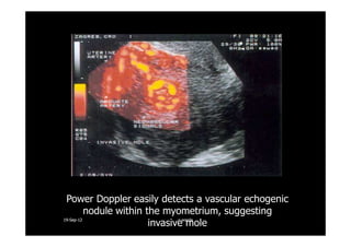 Power Doppler easily detects a vascular echogenic
nodule within the myometrium, suggesting
invasive mole1919--SepSep--1212 o wardao warda
 