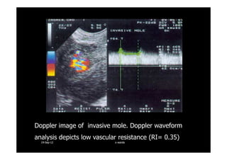 Doppler image of invasive mole. Doppler waveform
analysis depicts low vascular resistance (RI= 0.35)
1919--SepSep--1212 o wardao warda
 