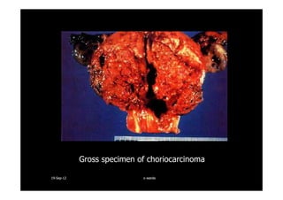 Gross specimen of choriocarcinoma
1919--SepSep--1212 o wardao warda
 