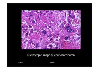Microscopic image of choriocarcinoma
1919--SepSep--1212 o wardao warda
 