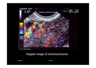 Doppler image of choriocarcinoma
1919--SepSep--1212 o wardao warda
 