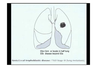 IIIa<3cm or locate in half lung
IIIb disease beyond IIIa
1919--SepSep--1212 o wardao warda
 