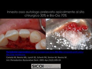 Innesti Ossei Di Idrossiapate Prodotti Trame CAD/CAM In - Foto 10