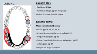 RAHANG ATAS
Cantilever Bridge
- Cantilever bridge gigi 27 dengan 26
- Bahan Porcelain Fused to Metal
RAHANG BAWAH
Metal Frame Partial Denture
- Anasir gigi 36, 44, 45, 46, 47
- A clasp dengan cingulum rest pada gigi 43
- Cingulum rest pada gigi 33
- Single Crown PFM dengan rest pada ackers gigi 35
- Ackers pada gigi 37
- Lingual bar major connector
DESIGN 1
 