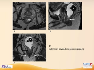 T3
Extension beyond muscularis propria
 