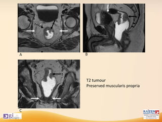 T2 tumour
Preserved muscularis propria
 