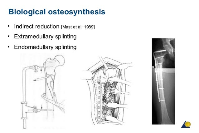 Osteosynthesis implants image