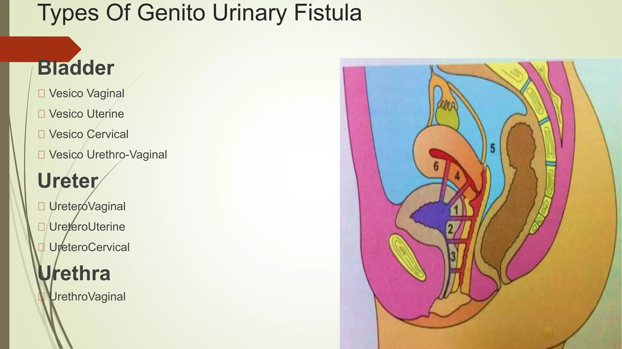 Urinary Tract Fistula PPTX urinary-tract-fistula-pptx