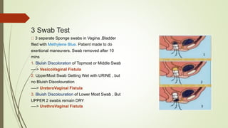 3 Swab Test
3 separate Sponge swabs in Vagina .Bladder
flled with Methylene Blue. Patient made to do
exertional maneuvers. Swab removed after 10
mins
1. Bluish Discoloration of Topmost or Middle Swab
----> VesicoVaginal Fistula
2. UpperMost Swab Getting Wet with URINE , but
no Bluish Discolouration
----> UreteroVaginal Fistula
3. Bluish Discolouration of Lower Most Swab , But
UPPER 2 swabs remain DRY
----> UrethroVaginal Fistula
 
