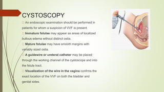 CYSTOSCOPY
An endoscopic examination should be performed in
patients for whom a suspicion of VVF is present
Immature fstulae may appear as areas of localized
bullous edema without distinct ostia.
Mature fstulae may have smooth margins with
variably sized ostia.
A guidewire or ureteral catheter may be placed
through the working channel of the cystoscope and into
the fstula tract.
Visualization of the wire in the vagina confrms the
exact location of the VVF on both the bladder and
genital sides.
 