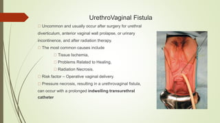 UrethroVaginal Fistula
Uncommon and usually occur after surgery for urethral
diverticulum, anterior vaginal wall prolapse, or urinary
incontinence, and after radiation therapy.
The most common causes include
Tissue Ischemia,
Problems Related to Healing,
Radiation Necrosis.
Risk factor – Operative vaginal delivery.
Pressure necrosis, resulting in a urethrovaginal fistula,
can occur with a prolonged indwelling transurethral
catheter
 