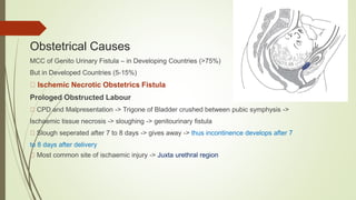 Obstetrical Causes
MCC of Genito Urinary Fistula – in Developing Countries (>75%)
But in Developed Countries (5-15%)
Ischemic Necrotic Obstetrics Fistula
Prologed Obstructed Labour
CPD and Malpresentation -> Trigone of Bladder crushed between pubic symphysis ->
Ischaemic tissue necrosis -> sloughing -> genitourinary fistula
Slough seperated after 7 to 8 days -> gives away -> thus incontinence develops after 7
to 8 days after delivery
Most common site of ischaemic injury -> Juxta urethral region
 