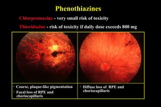 45 drug related retinopathies | PPT