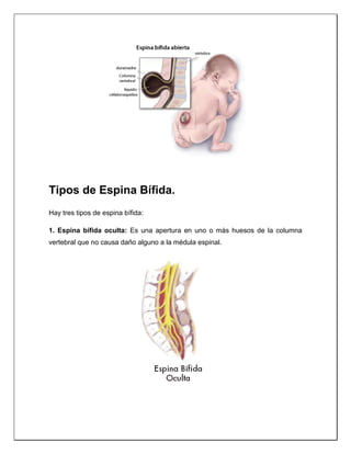 Tipos de Espina Bífida.
Hay tres tipos de espina bífida:
1. Espina bífida oculta: Es una apertura en uno o más huesos de la columna
vertebral que no causa daño alguno a la médula espinal.
 