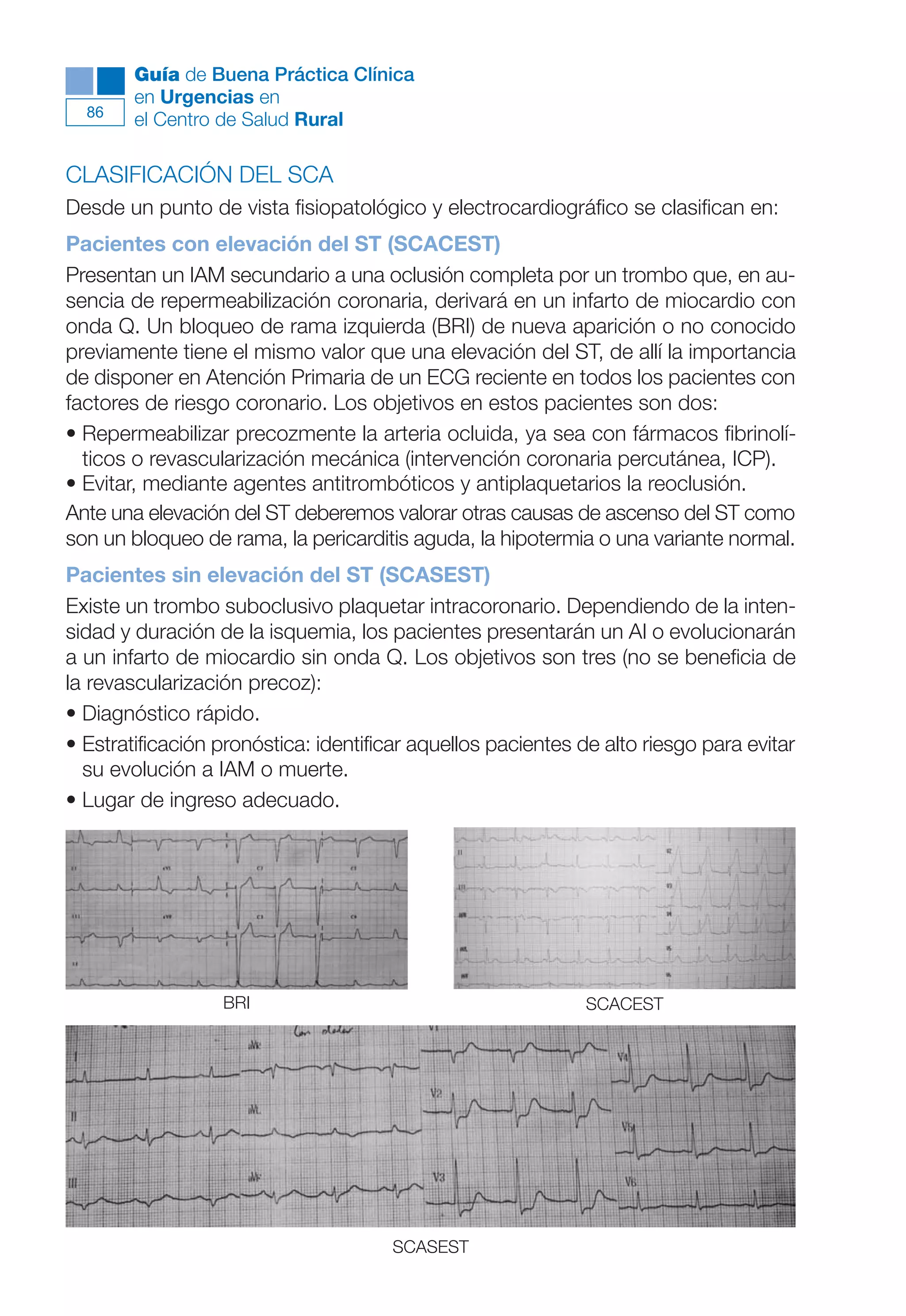 Maqueta V6.5.qxd   14/6/11    15:56   Página 86




              Guía de Buena Práctica Clínica
              en Urgencias en
        86
              el Centro de Salud Rural

      CLASIFICACIÓN DEL SCA
      Desde un punto de vista fisiopatológico y electrocardiográfico se clasifican en:
      Pacientes con elevación del ST (SCACEST)
      Presentan un IAM secundario a una oclusión completa por un trombo que, en au-
      sencia de repermeabilización coronaria, derivará en un infarto de miocardio con
      onda Q. Un bloqueo de rama izquierda (BRI) de nueva aparición o no conocido
      previamente tiene el mismo valor que una elevación del ST, de allí la importancia
      de disponer en Atención Primaria de un ECG reciente en todos los pacientes con
      factores de riesgo coronario. Los objetivos en estos pacientes son dos:
      • Repermeabilizar precozmente la arteria ocluida, ya sea con fármacos fibrinolí-
        ticos o revascularización mecánica (intervención coronaria percutánea, ICP).
      • Evitar, mediante agentes antitrombóticos y antiplaquetarios la reoclusión.
      Ante una elevación del ST deberemos valorar otras causas de ascenso del ST como
      son un bloqueo de rama, la pericarditis aguda, la hipotermia o una variante normal.
      Pacientes sin elevación del ST (SCASEST)
      Existe un trombo suboclusivo plaquetar intracoronario. Dependiendo de la inten-
      sidad y duración de la isquemia, los pacientes presentarán un AI o evolucionarán
      a un infarto de miocardio sin onda Q. Los objetivos son tres (no se beneficia de
      la revascularización precoz):
      • Diagnóstico rápido.
      • Estratificación pronóstica: identificar aquellos pacientes de alto riesgo para evitar
        su evolución a IAM o muerte.
      • Lugar de ingreso adecuado.




                        BRI                                        SCACEST




                                             SCASEST
 