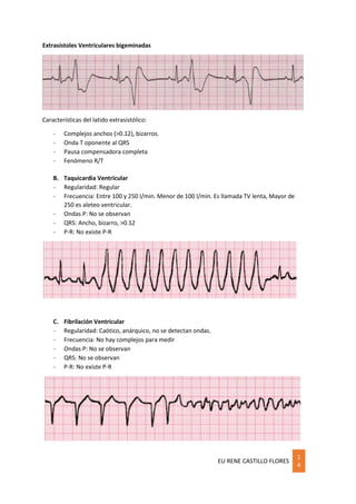 EU RENE CASTILLO FLORES
1
4
Extrasístoles Ventriculares bigeminadas
Características del latido extrasistólico:
- Complejos anchos (>0.12), bizarros.
- Onda T oponente al QRS
- Pausa compensadora completa
- Fenómeno R/T
B. Taquicardia Ventricular
- Regularidad: Regular
- Frecuencia: Entre 100 y 250 l/min. Menor de 100 l/min. Es llamada TV lenta, Mayor de
250 es aleteo ventricular.
- Ondas P: No se observan
- QRS: Ancho, bizarro, >0.12
- P-R: No existe P-R
C. Fibrilación Ventricular
- Regularidad: Caótico, anárquico, no se detectan ondas.
- Frecuencia: No hay complejos para medir
- Ondas P: No se observan
- QRS: No se observan
- P-R: No existe P-R
 