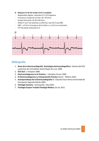 EU RENE CASTILLO FLORES
1
7
D. Bloqueo A-V de 3er Grado o B-A-V completo
- Regularidad: Regular. Intervalos P-P y R-R regulares
- Frecuencia: Escape de la Unión: 40 - 60 l/min..
- Escape Ventricular: de 20 a 40 l/min..
- Ondas P: Las P son positivas y uniformes, hay más P que QRS.
- QRS: < a 0.12 si el escape es de la Unión y > a 0.12 si es ventricular.
- P-R: No existe conducción A-V
Bibliografía
1. Bases de la electrocardiografía. Semiología electrocardiográfica I , Génesis del ECG
y patrones de normalidad. Antoni Bayés de Luna. 2006
2. ECG fácil. J. Hampton 2008
3. Electrocardiograma en la Práctica. J. Hampton 5ta ed. 2009
4. El Electrocardiograma su Interpretación Practica Hamm - Willems 2010
5. Autoaprendizaje de la Electrocardiografía Dr. Eduardo Fasce Henry Universidad de
Concepción Segunda Edición 2003
6. Fisiología Humana - Ganong Edic. 23va 2010
7. Fisiología Guyton Tratado Fisiología Medica 12a ed. 2011
 