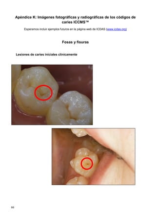 66
Apéndice K: Imágenes fotográficas y radiográficas de los códigos de
caries ICCMS™
Esperamos incluir ejemplos futuros en la página web de ICDAS (www.icdas.org)
Fosas y fisuras
Lesiones de caries iniciales clinicamente
 