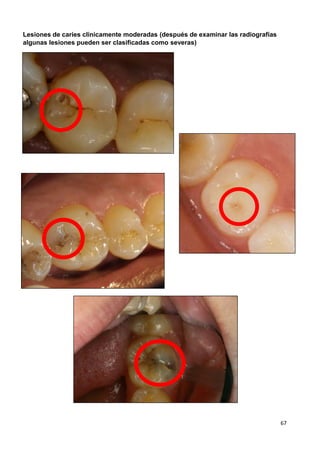 67
Lesiones de caries clínicamente moderadas (después de examinar las radiografías
algunas lesiones pueden ser clasificadas como severas)
 
