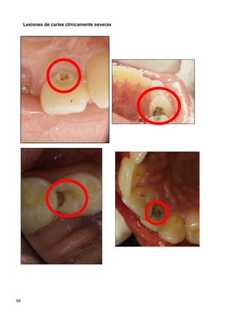 68
Lesiones de caries clínicamente severas
 