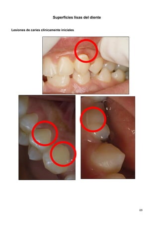 69
Superficies lisas del diente
Lesiones de caries clínicamente iniciales
 