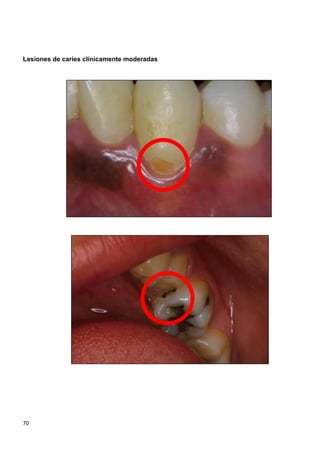 70
Lesiones de caries clínicamente moderadas
 