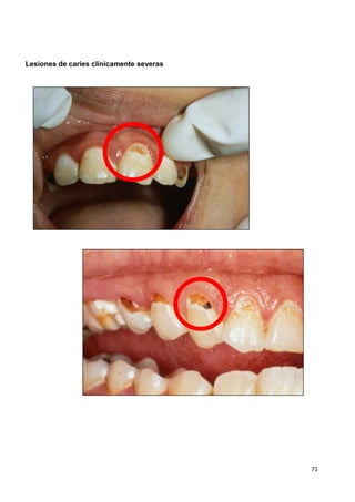 71
Lesiones de caries clínicamente severas
 