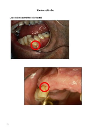 72
Caries radicular
Lesiones clínicamente no-cavitadas
 